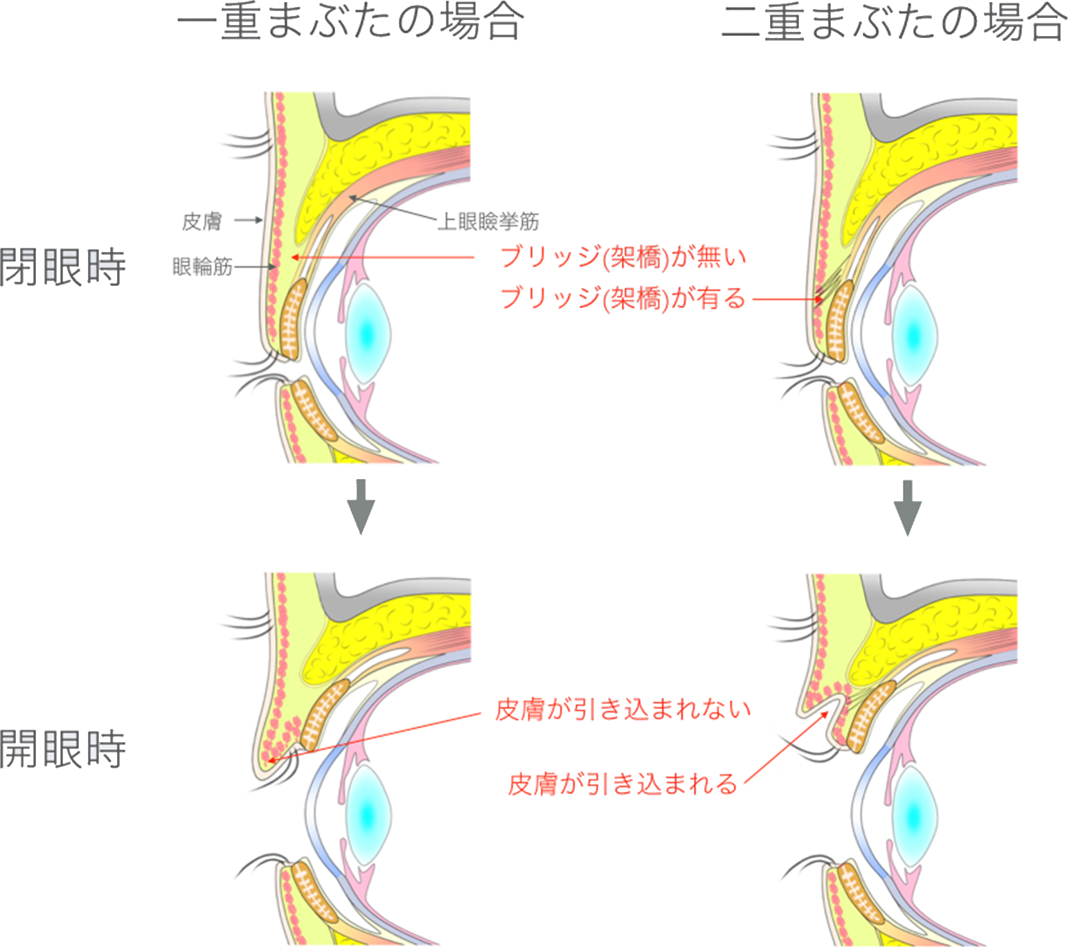 二重まぶたになる仕組み