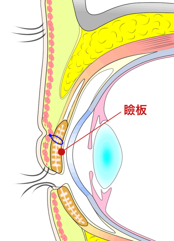 瞼板法