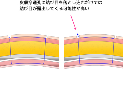 皮膚側での微小切開の工夫