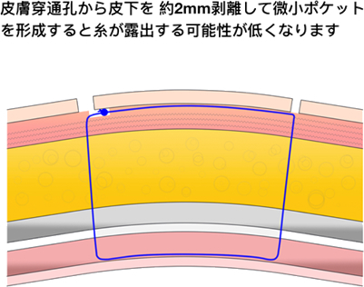 糸の結び目が入り込む微小ポケット