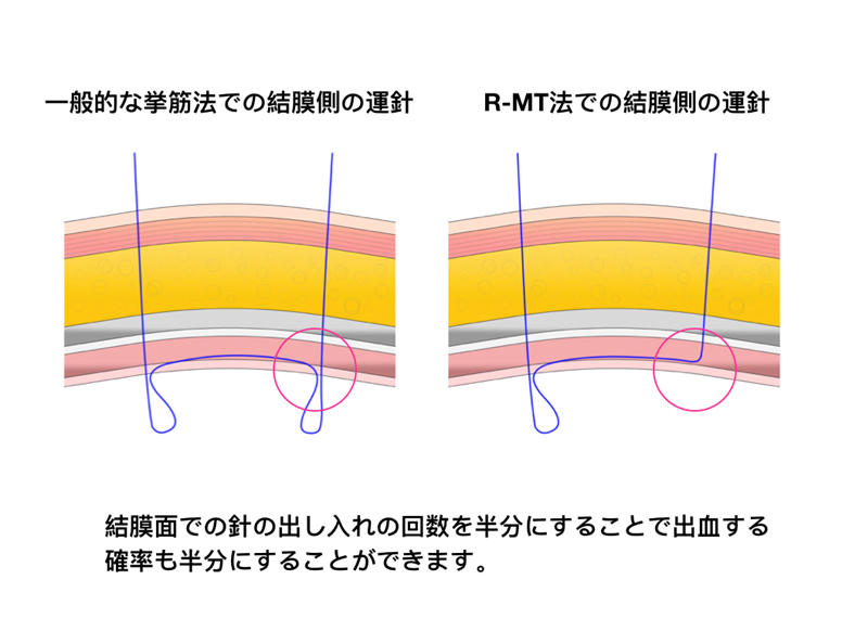 結膜側での運針ポイント