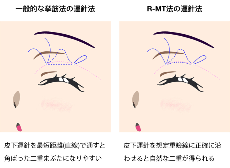 皮下での運針ポイント