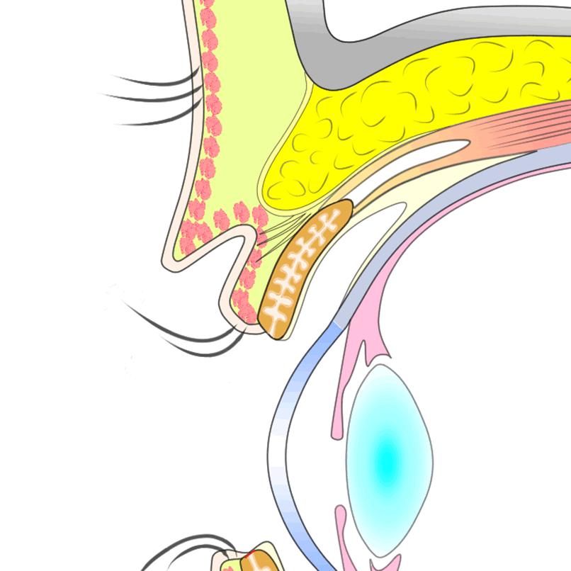 上眼瞼挙筋が収縮すると自然な二まぶたに