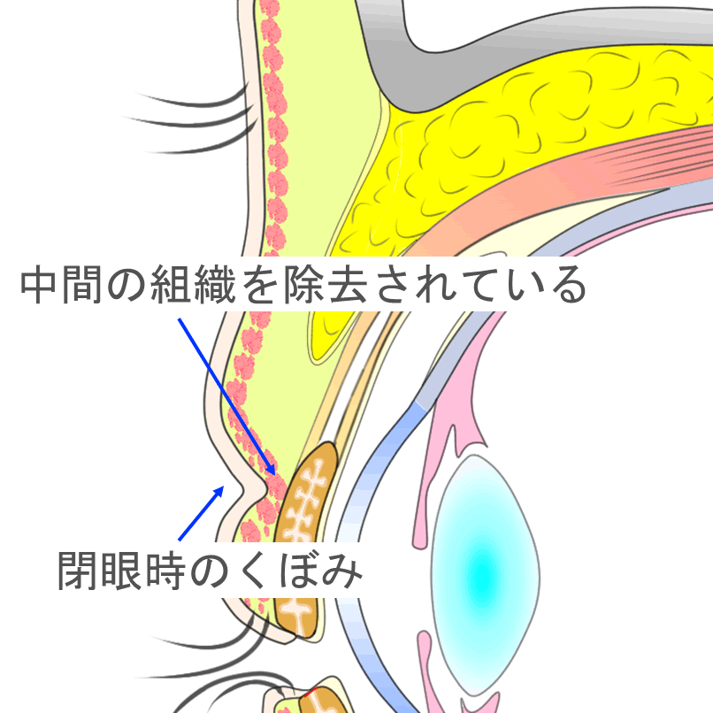 解剖学的相似性が低い二重切開法