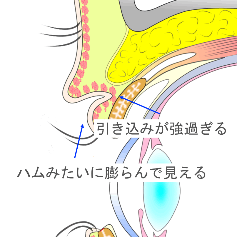 引き込みが強く不自然な二重まぶたに