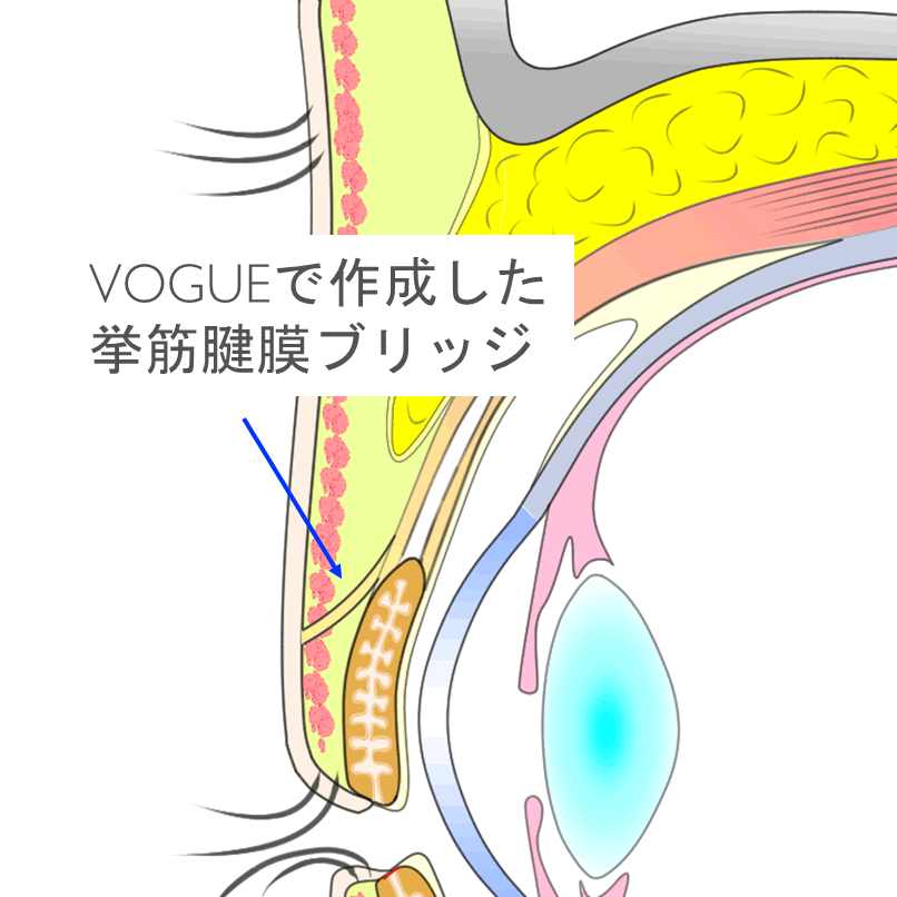 解剖学的相似性が高い手術法二重切開法VOGUEの術後構造