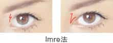 Imre法(Z形成術)