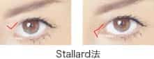 Stallard法(変形Z形成術)