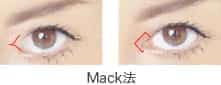 Mack法(Y-V形成術)