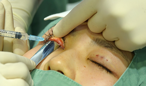角膜保護板の使用