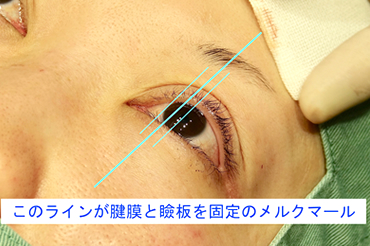 「開眼」状態での挙筋腱膜と瞼板固定位置のメルクマール