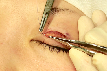 挙筋腱膜と瞼板の固定処理