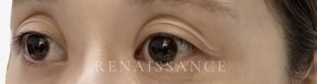処置前